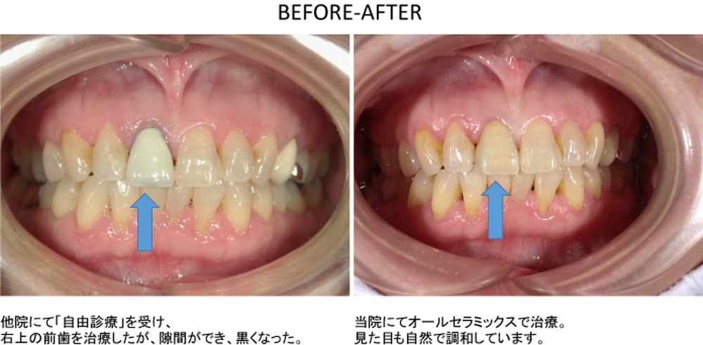 セラミック治療の利点について