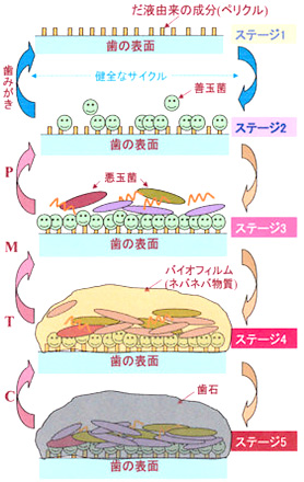 歯石除去、なぜ３カ月に一度？