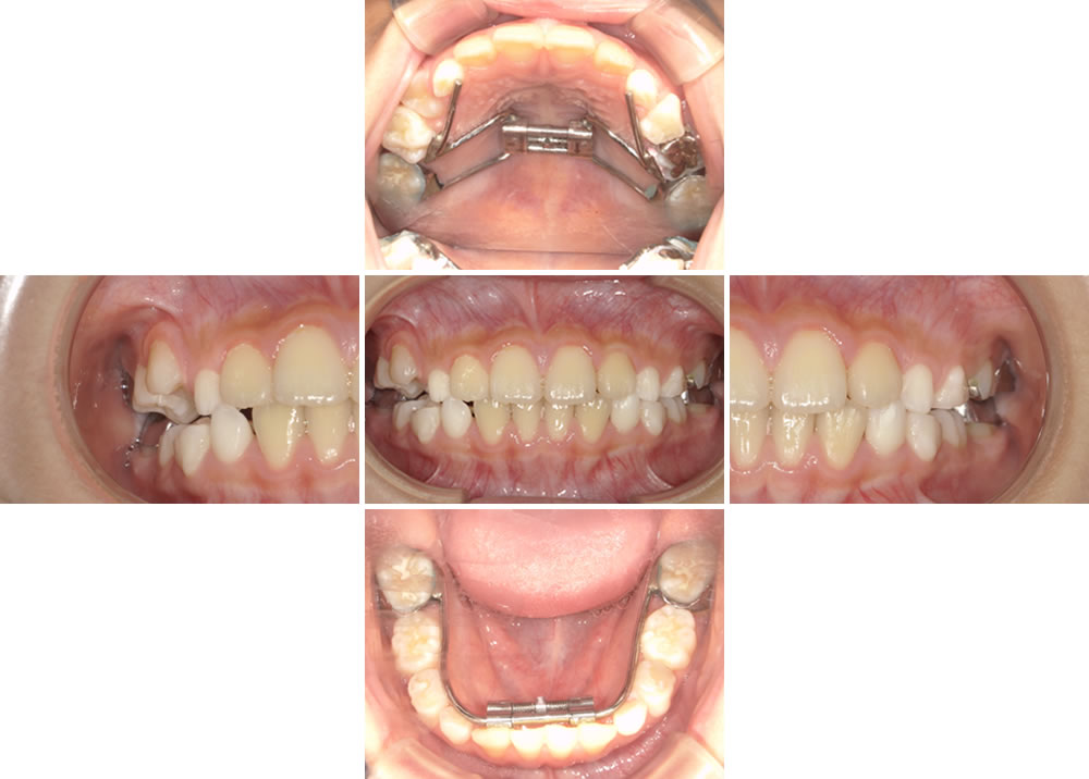 拡大装置装着後の経過