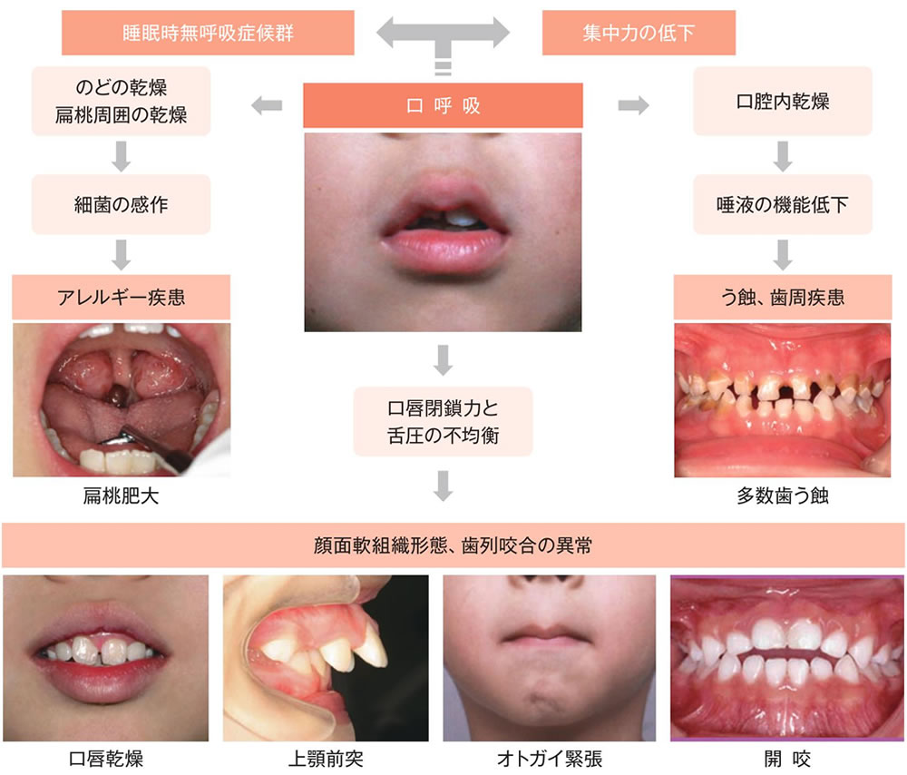 口唇閉鎖不全症(口呼吸)