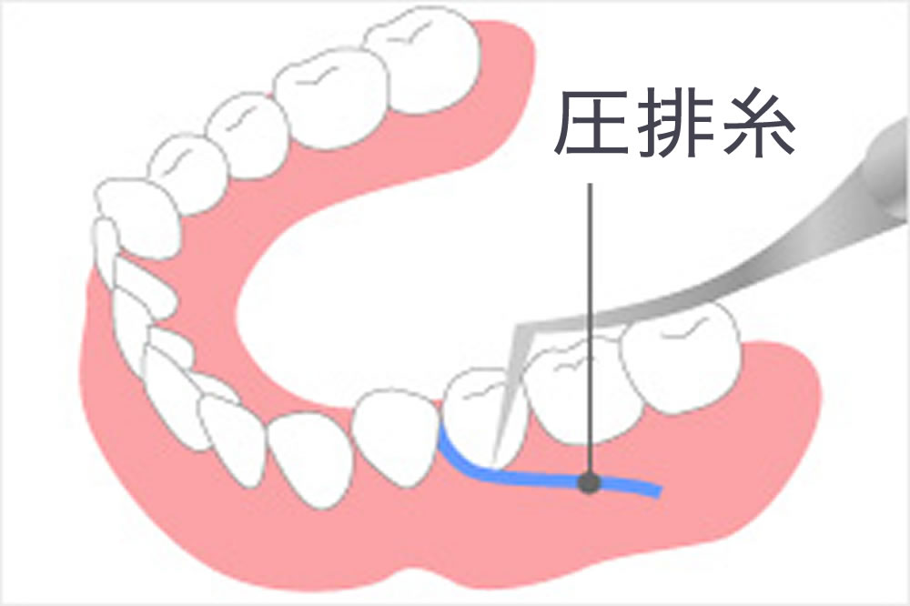 歯肉縁下