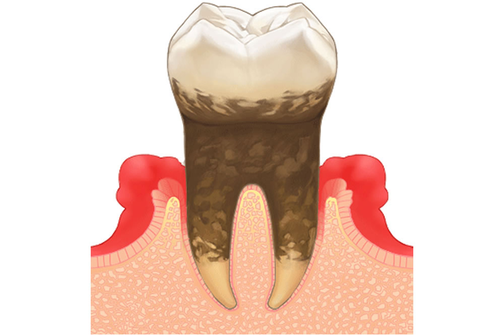 虫歯・歯周病治療