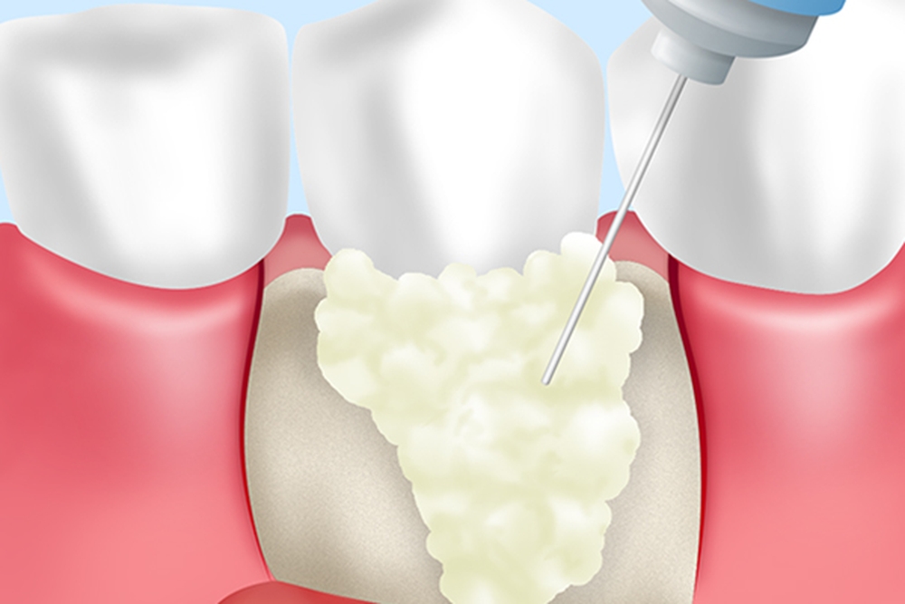 歯周組織の再生