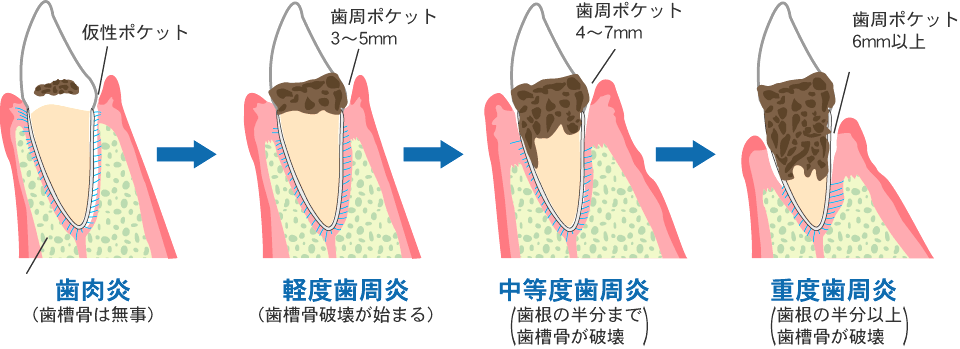 早期発見、早期治療