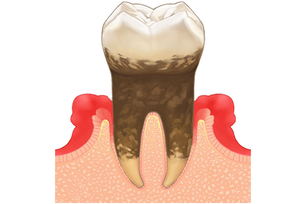 歯周病の理解