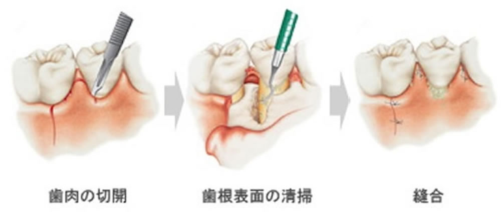 歯周外科治療(フラップ手術)