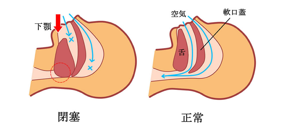 睡眠時無呼吸症候群（いびき）が起こる仕組み